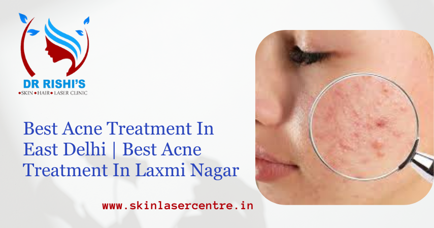 Best Acne Treatment In East Delhi | Best Acne Treatment In Laxmi Nagar